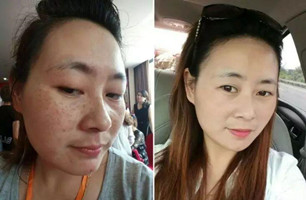 合肥韩美祛斑案例果好吗？术后能够改善哪些问题？