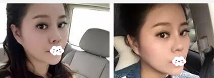 江门华美整形美容医院怎么样？所做的鼻整形果怎么样？