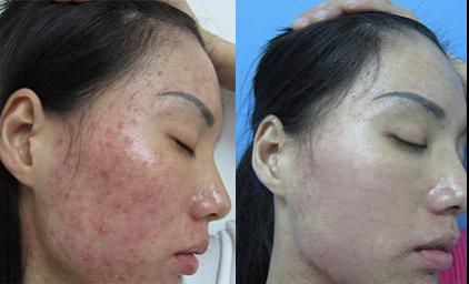 石家庄好的痤疮医院是哪家？痤疮治疗完成后果好吗？