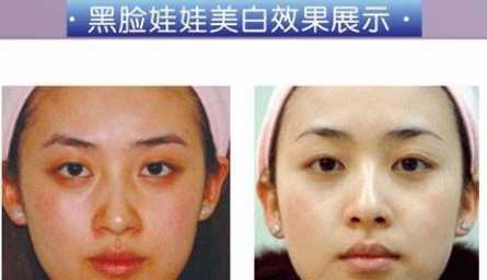 黑脸娃娃疗程是怎样的?有哪些需要注意的事项?