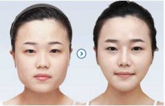 注射瘦脸生物除皱怎么样？有什么优缺点？