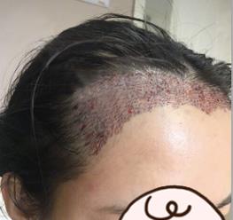 在合肥韩美成功的完成了美人尖发际线