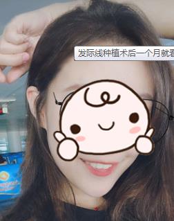 在合肥韩美成功的完成了美人尖发际线