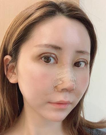 几万块做的自体肋软骨隆鼻果超赞，毫不后悔