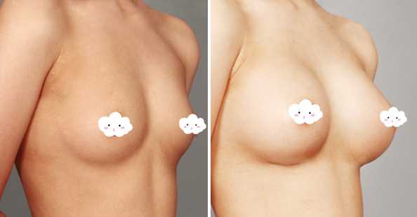娜绮丽隆胸多少钱?隆胸手术没问题吗?