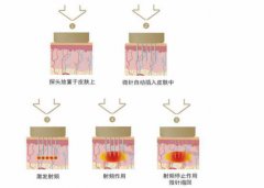 黄金微针能维持几年？手术有什么注意事项？