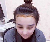 美人尖整形案例对比照,美人尖术后果如何？