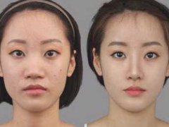 隆鼻前后对比果图片展示,隆鼻对脸型变化大吗?