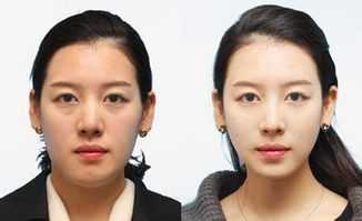 义乌欧莱美注射瘦脸果分享,有什么案例吗？