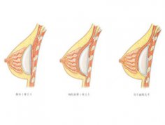 女子隆胸对身体有害吗?各种隆胸方法的优势是怎么样的?