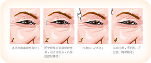 去除鱼尾纹医院哪家好?注射瘦脸注射真的能够改善鱼尾纹吗?