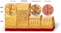 石家庄吸脂哪个医院比较好?案例前后对比照片和案例分析，术后果展示