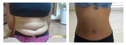 石家庄吸脂哪个医院比较好?案例前后对比照片和案例分析,术后果展示