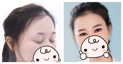 植眉毛一般价格要多少钱?成都丝恒植发的植眉果好不好?