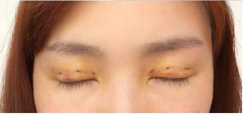 武汉的周旭做双眼皮手术好吗?有没有真实的案例?