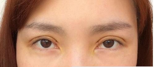 武汉的周旭做双眼皮手术好吗?有没有真实的案例?