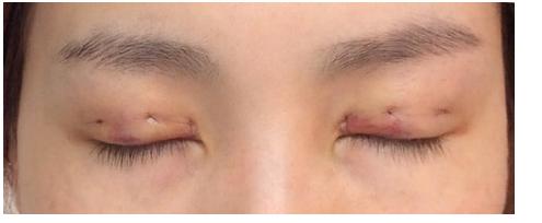 武汉的周旭做双眼皮手术好吗?有没有真实的案例?