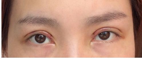 武汉的周旭做双眼皮手术好吗?有没有真实的案例?