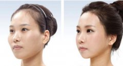 磨颧骨前后有什么区别？磨颧骨的优点有什么？有？