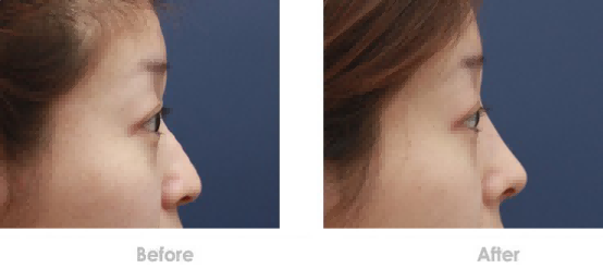 武汉的徐国建医生隆鼻怎么样？有没有人不适合隆鼻？