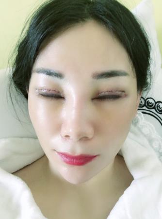 朱希敏医生做的眼部手术果怎么样?附恢复对比图