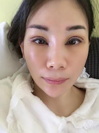 朱希敏医生做的眼部手术果怎么样？附恢复对比图