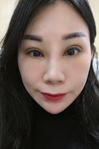 朱希敏医生做的眼部手术果怎么样？附恢复对比图