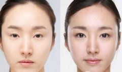 开眼尾多少钱，手术后应该注意哪些问题？