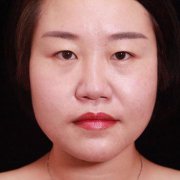 上海九院的开眼角怎么样？整形科开眼角恢复果图对比