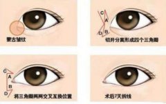 开眼角的价格贵吗？原理又是什么，优势在哪？