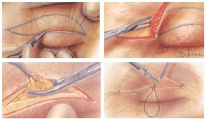 东莞华美割双眼皮怎么样?会不会留下什么后遗症?