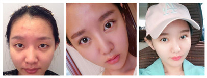 东莞华美割双眼皮怎么样?会不会留下什么后遗症?