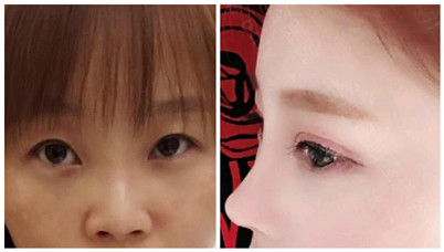合肥壹加壹马璐医生的整形技术怎么样?做的眼鼻手术能不能改善自身的缺陷?