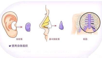 知名整形医师张少军简介以及隆鼻案例分享