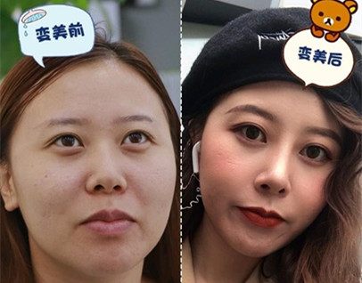 知名整形医师张少军简介以及隆鼻案例分享