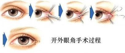 张少军医生开眼角手术做的怎么样?实际的案例分享