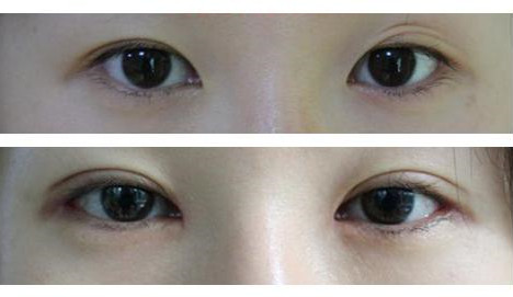 张少军医生开眼角手术做的怎么样?实际的案例分享