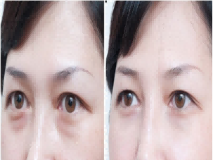 北京超声波去眼袋怎么做的?价格如何?