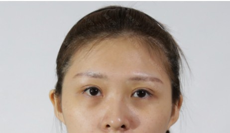 武汉美之仁医疗美容怎么样?真实案例分享