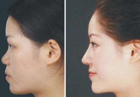 袁志玮医生做手术技术怎么样？有没有真实案例？