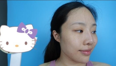 侯舍予医生做面部填充靠谱吗?有没有案例分享?