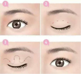 整形医生江凌肃的技术怎么样?可以割双眼皮吗?