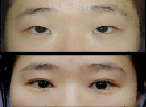 整形医生江凌肃的技术怎么样?可以割双眼皮吗?