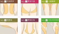 宁波姚远医生吸脂的技术怎么样?附相关案例展示