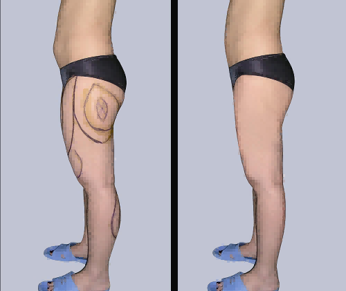 宁波姚远医生吸脂的技术怎么样?附相关案例展示