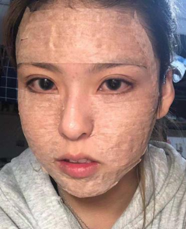 深圳和平医院面部脂肪填充果？附真人前后对比图