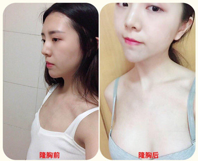 董新医生的整形技术怎么样?隆胸案例分享---价格