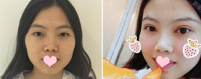 整形医生朴哲洪的技术实力怎么样那?切开双眼皮手术的案例分享