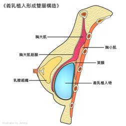顺德国丹康复医院做的复合隆胸果好不好?案例分享/价格查询