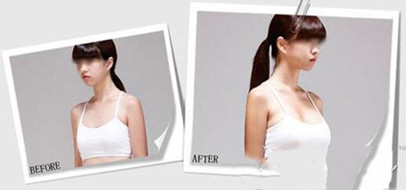 顺德国丹康复医院做的复合隆胸果好不好?案例分享/价格查询
